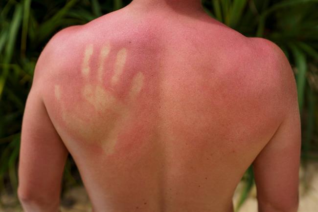 Blažje sončne opekline lahko poskusite lajšati z naravnimi pripravki. (Foto: Freepik.com)