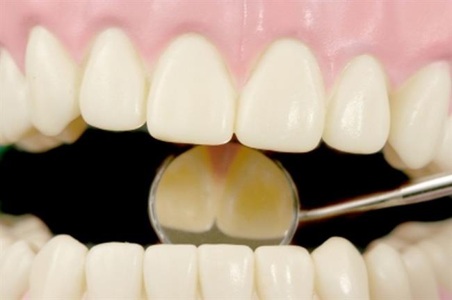 Pri poškodbi zob se posvetujte z zobozdravnikom. (foto: FreeDigitalPhotos.net)