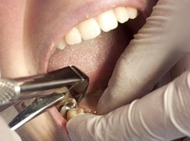 Izdiranje zoba: Nasveti, ki vam bodo pomagali do hitrejšega okrevanja