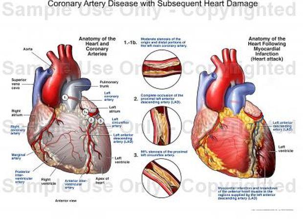 Arterijska bolezen nog lahko povzroči celo srčno kap. 