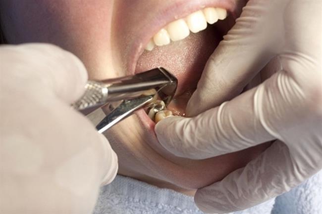 Ekstrakcija zoba je rutinski poseg, kjer so zapleti redki. (foto: FreeDigitalPhotos.net)