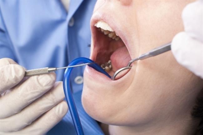 Pred namestitvijo fiksnega zobnega aparata, je potrebno zobe temeljito očistiti. (foto: FreeDigitalPhotos.net)