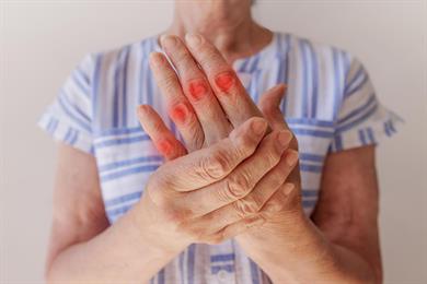 5 načinov, kako ustaviti artritis